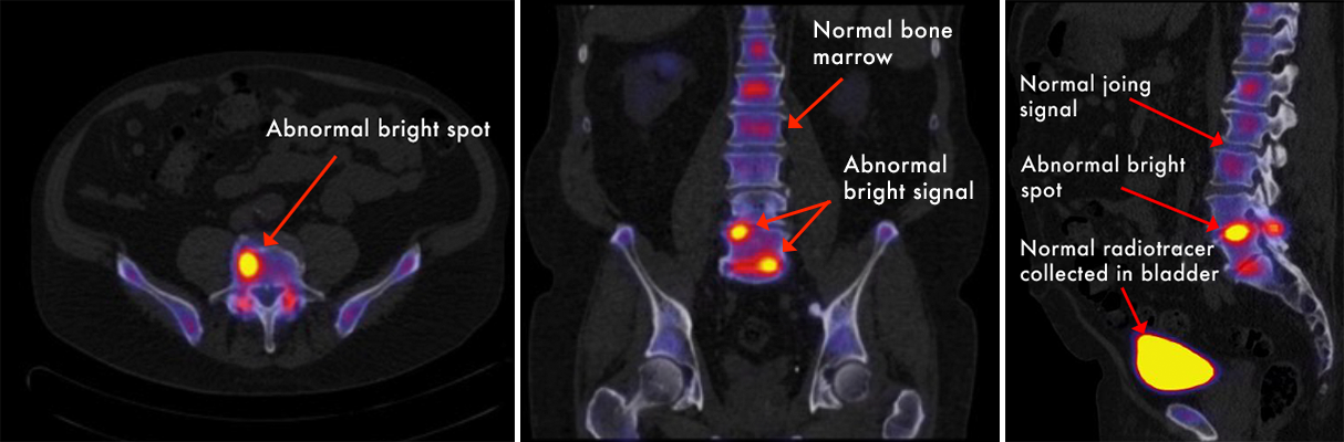 SPECT-CT Scan